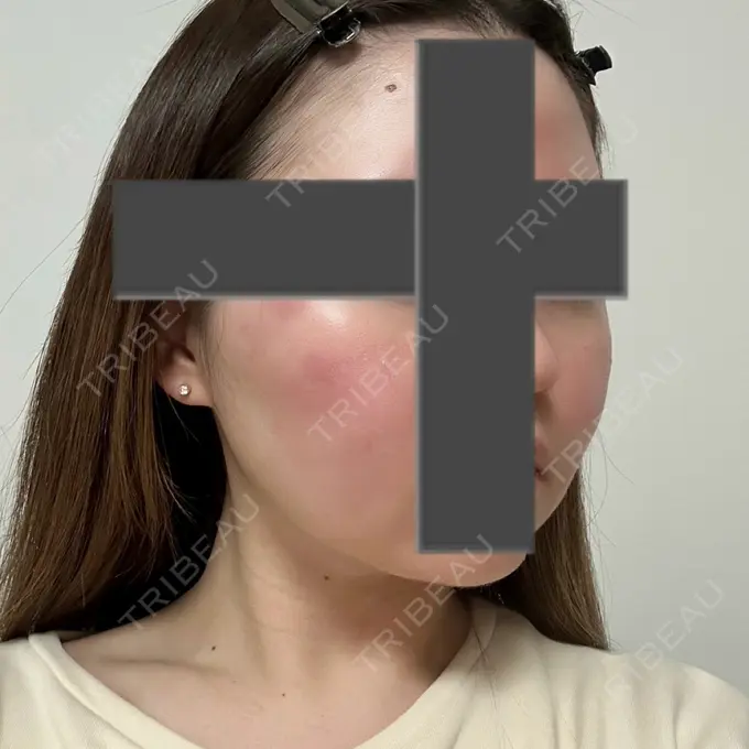 脂肪吸引（顔） / ジョールファット除去 / ヒアルロン酸注入（あご） / ボトックス（エラ・小顔） Otus Clinic 【オータスクリニック】 DAY 92 メイン用