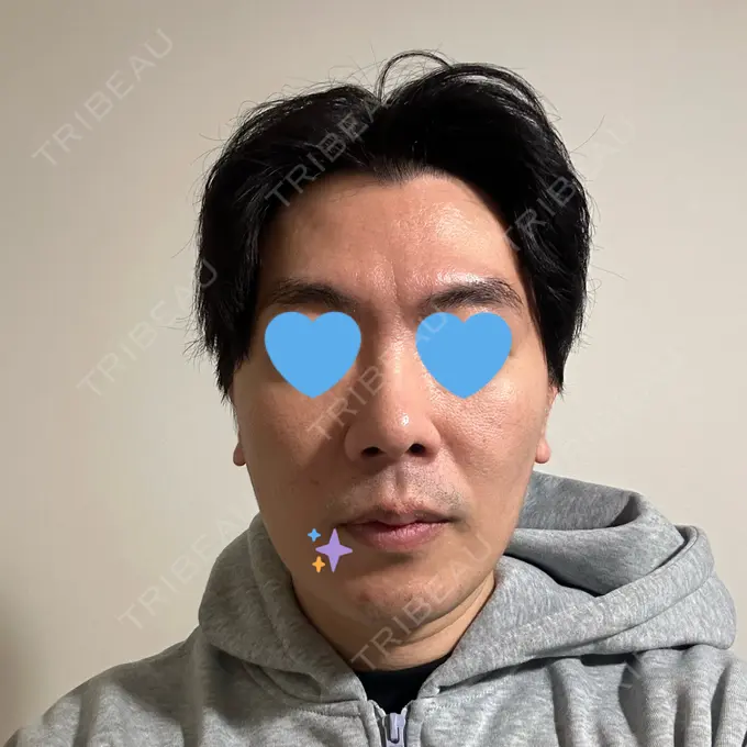 糸リフト / バッカルファット除去 / 脂肪吸引（顔） / メーラーファット除去 / ボトックス（エラ・小顔） RIVER CLINIC（リバークリニック） DAY 40 メイン用