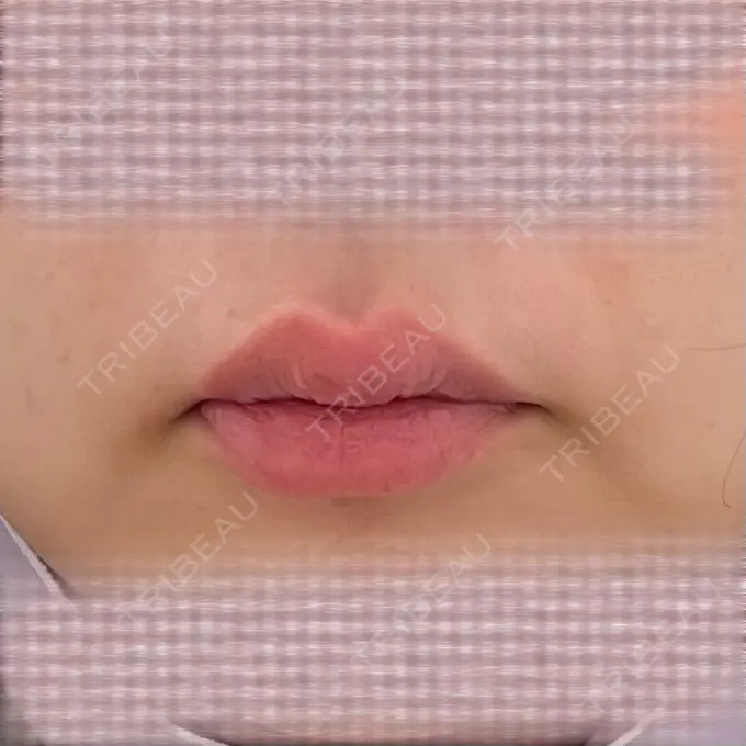 口角挙上 宇都宮竹内クリニック AFTER メイン用