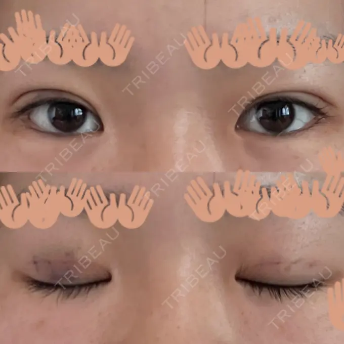 二重埋没 / ヒアルロン酸注入（涙袋） 藤・ナチュレ美容クリニック 銀座院 DAY 3 メイン用