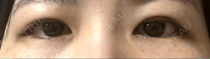 二重埋没 日本ウェルネス再生クリニック AFTER メイン用