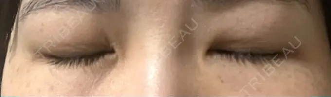 二重埋没 日本ウェルネス再生クリニック DAY 23 メイン用