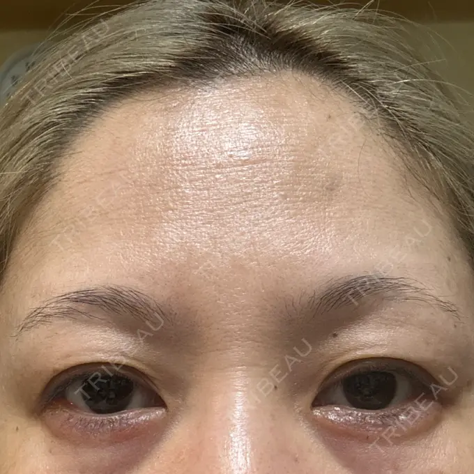 ヒアルロン酸注入（涙袋） / ボトックス（額） 渋谷美容外科クリニック 渋谷院 DAY 1 メイン用