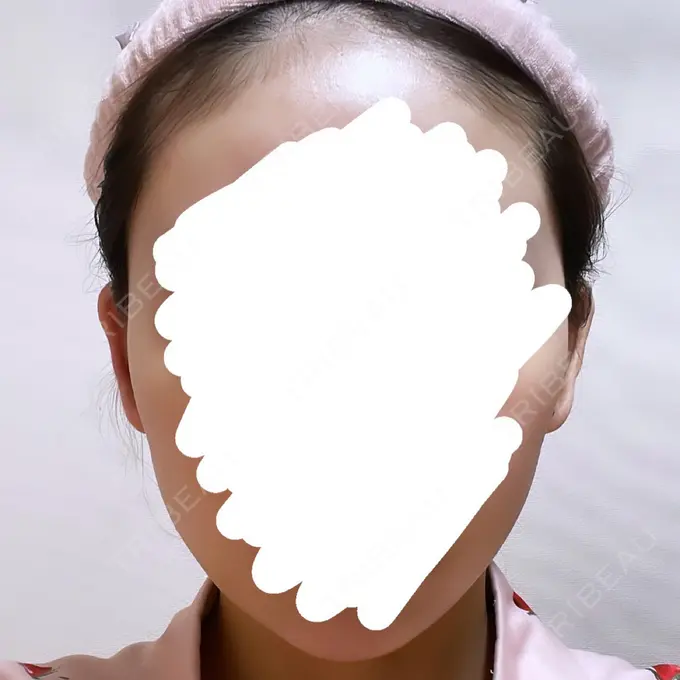 脂肪吸引（顔） Mods Clinic（モッズクリニック） 名古屋院 DAY 10 メイン用