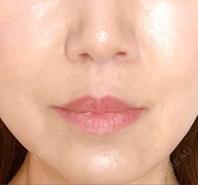 小鼻縮小（切開） / 人中短縮 Otus Clinic 【オータスクリニック】 DAY 304 メイン用