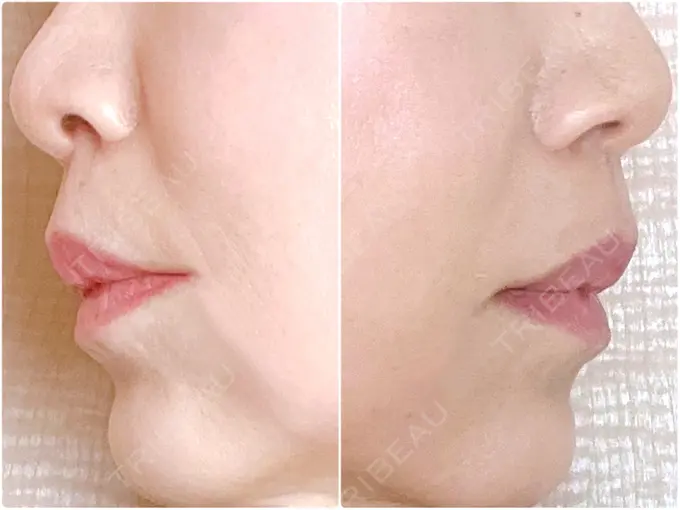 小鼻縮小（切開） / 人中短縮 Otus Clinic 【オータスクリニック】 DAY 304 メイン用