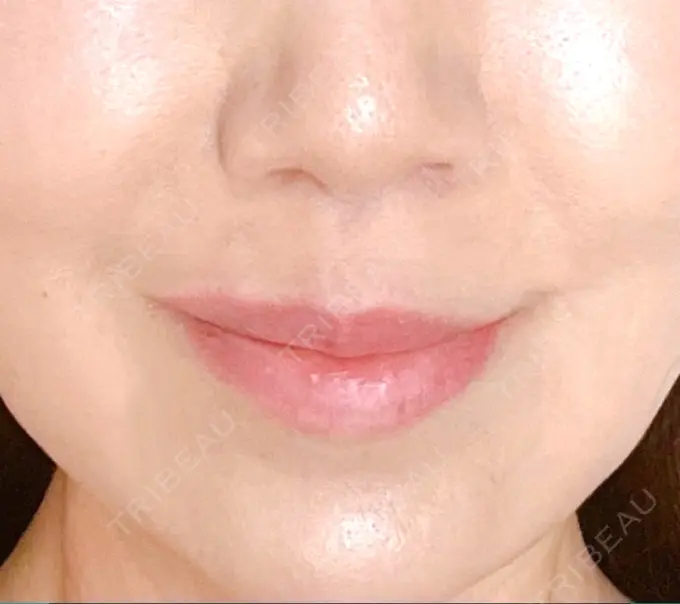 小鼻縮小（切開） / 人中短縮 Otus Clinic 【オータスクリニック】 DAY 304 メイン用