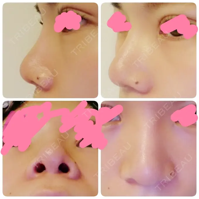 隆鼻術 / 鼻尖形成（切開） / 鼻尖縮小 ヤスミクリニック DAY 12 メイン用