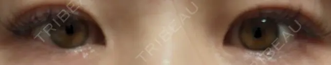 二重埋没 OMI CLINIC 【オミクリニック】 AFTER メイン用