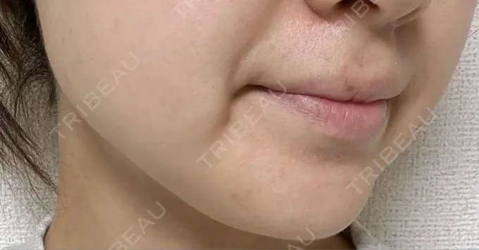 ボトックス（エラ・小顔） / 脂肪溶解注射（顔） CLINIC W DAY 0 メイン用