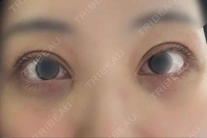 二重埋没 / 目頭切開 / クマ治療 / 目尻切開 / タレ目形成・グラマラスライン（切開） EMMA CLINIC（エマクリニック） DAY 34 メイン用