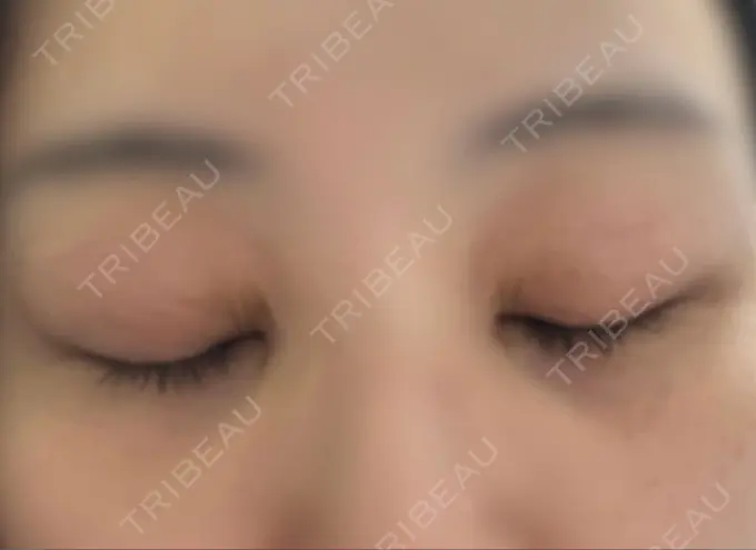 二重埋没 / 目頭切開 / クマ治療 / 目尻切開 / タレ目形成・グラマラスライン（切開） EMMA CLINIC（エマクリニック） DAY 34 メイン用