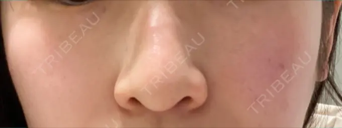 ピコレーザートーニング（美白・肝斑） SIGNATURE CLINIC 銀座 DAY 13 メイン用