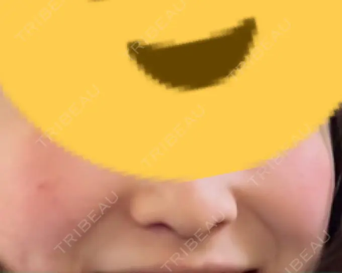 ピコレーザートーニング（美白・肝斑） SIGNATURE CLINIC 銀座 DAY 15 メイン用