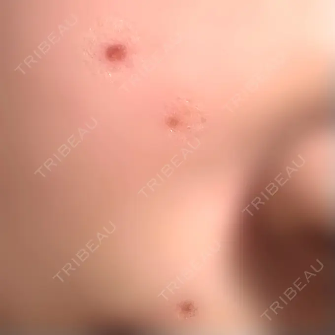 ほくろ・いぼ除去レーザー（肌） Fellez Clinic【フェルズクリニック】 DAY 10 メイン用