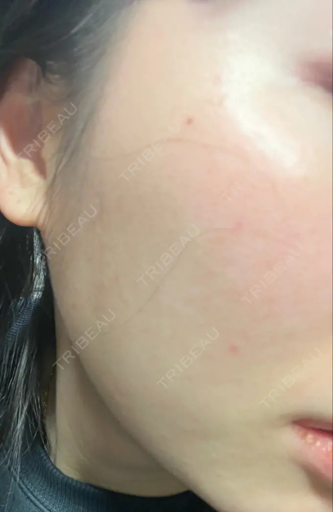 光治療（フォトフェイシャルなど） B-LINE CLINIC 池袋院 DAY 1 メイン用