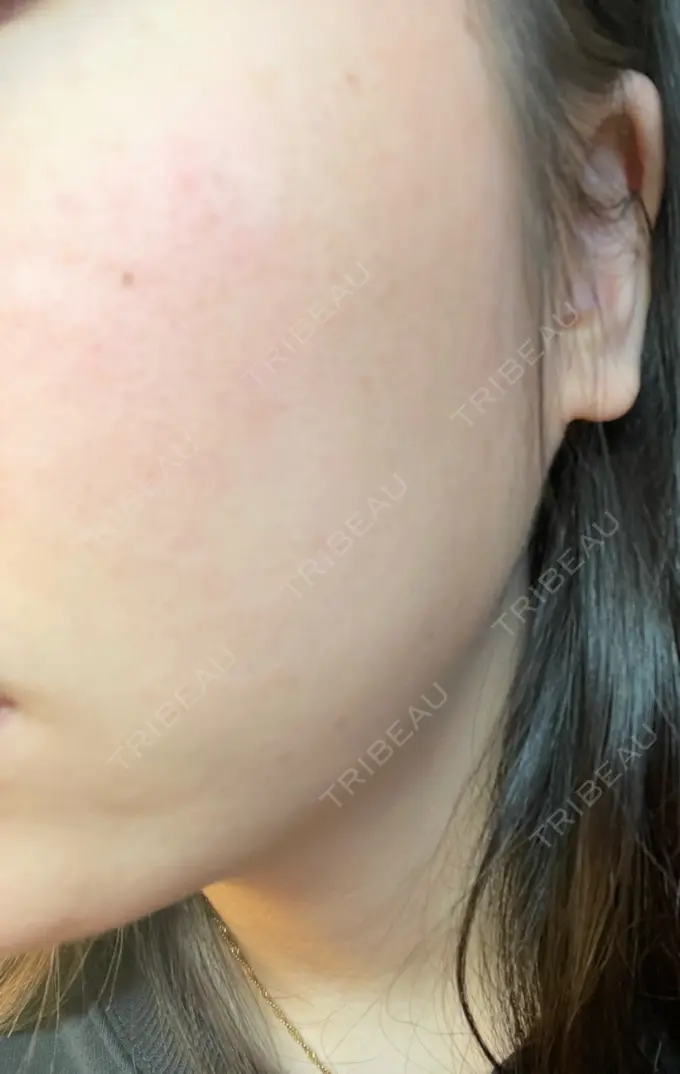 光治療（フォトフェイシャルなど） B-LINE CLINIC 池袋院 DAY 4 メイン用