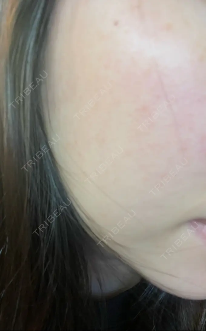 光治療（フォトフェイシャルなど） B-LINE CLINIC 池袋院 DAY 4 メイン用