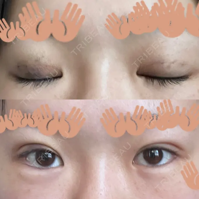 二重埋没 / ヒアルロン酸注入（涙袋） 藤・ナチュレ美容クリニック 銀座院 DAY 4 メイン用