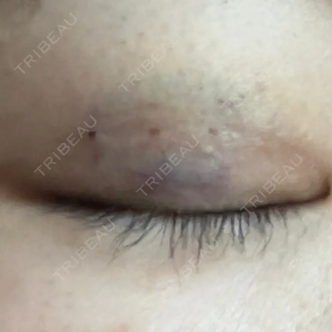 二重埋没 / ヒアルロン酸注入（涙袋） 藤・ナチュレ美容クリニック 銀座院 DAY 4 メイン用