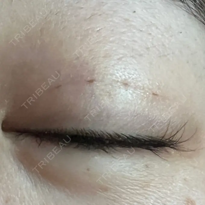 二重埋没 / ヒアルロン酸注入（涙袋） 藤・ナチュレ美容クリニック 銀座院 DAY 4 メイン用