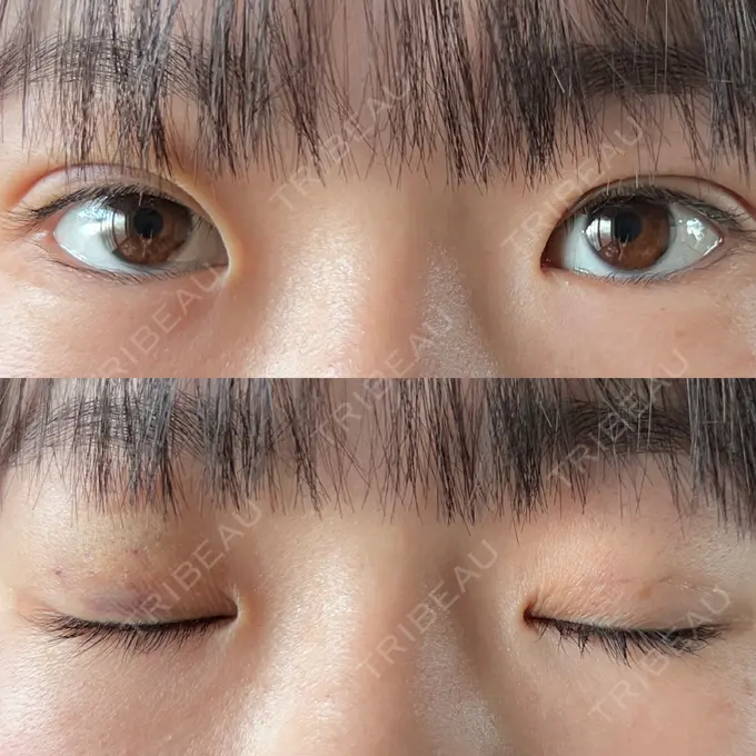 二重埋没 / ヒアルロン酸注入（涙袋） 藤・ナチュレ美容クリニック 銀座院 DAY 5 メイン用