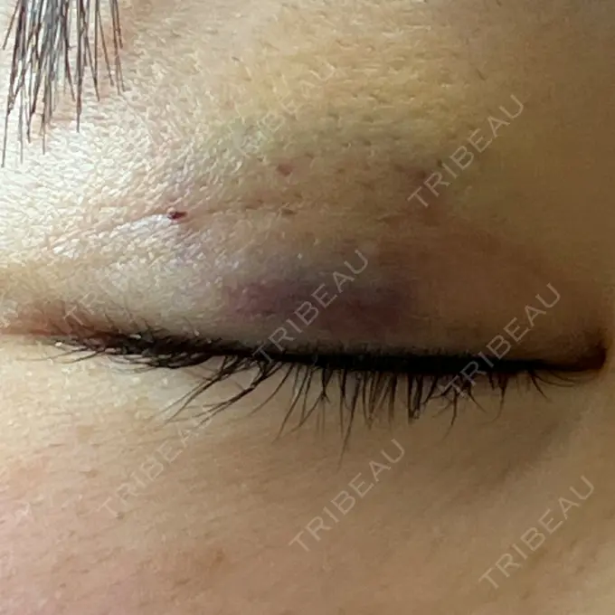 二重埋没 / ヒアルロン酸注入（涙袋） 藤・ナチュレ美容クリニック 銀座院 DAY 5 メイン用