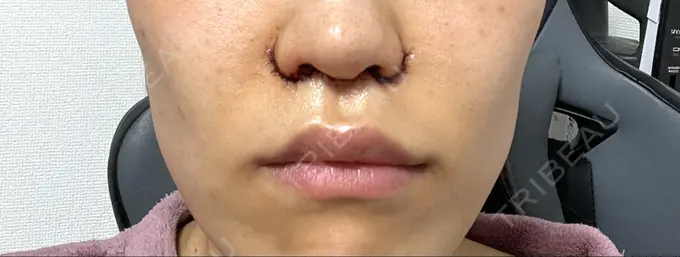 小鼻縮小（切開） / 人中短縮 Otus Clinic 【オータスクリニック】 DAY 0 メイン用