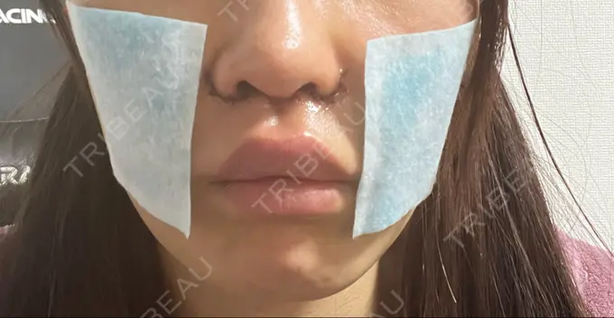 小鼻縮小（切開） / 人中短縮 Otus Clinic 【オータスクリニック】 DAY 1 メイン用