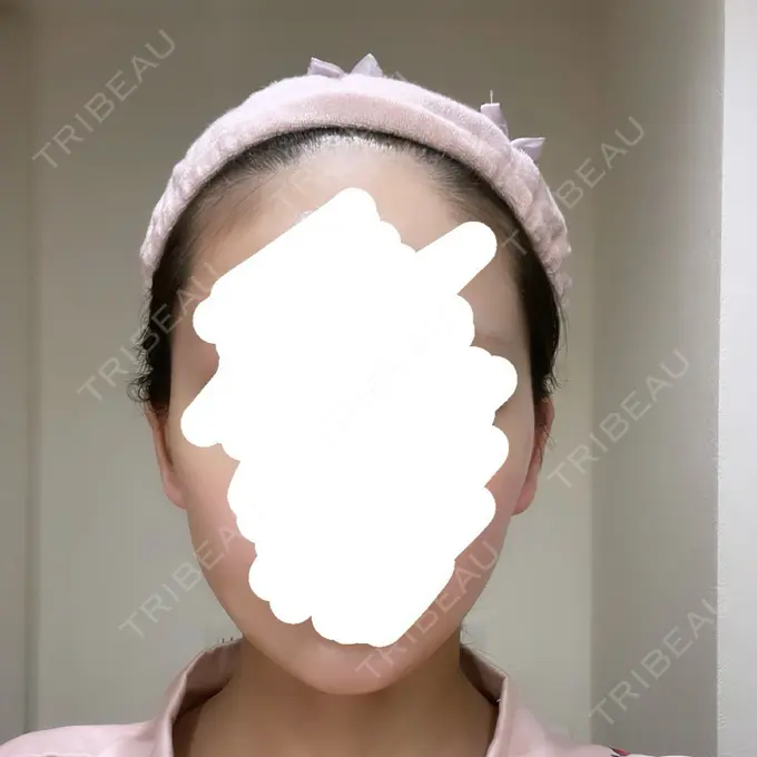 脂肪吸引（顔） Mods Clinic（モッズクリニック） 名古屋院 DAY 12 メイン用