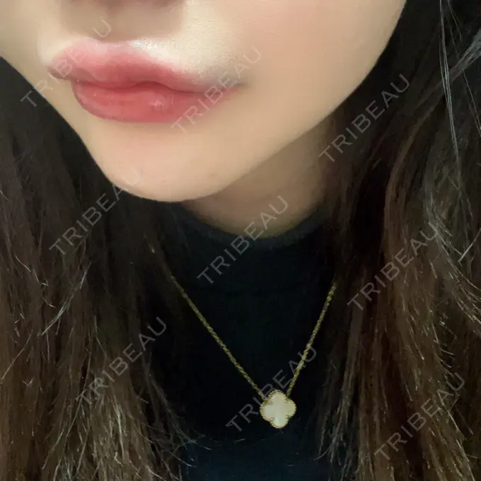 ヒアルロン酸注入（唇） / ボトックス（口角） L‘amour clinic Tokyo【ラムールクリニック東京】 DAY 0 メイン用