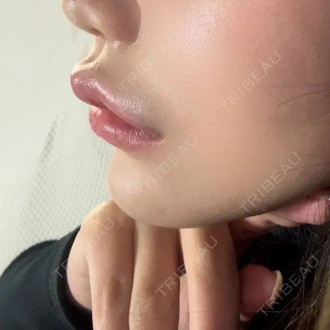 ヒアルロン酸注入（唇） / ボトックス（口角） L‘amour clinic Tokyo【ラムールクリニック東京】 DAY 0 メイン用