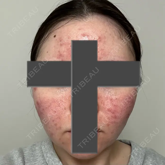 ニードルRF（ポテンツァなど） 東京美容外科 池袋院 DAY 2 メイン用