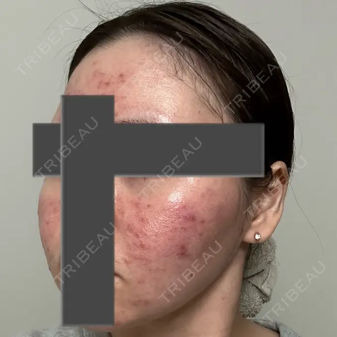 ニードルRF（ポテンツァなど） 東京美容外科 池袋院 DAY 2 メイン用