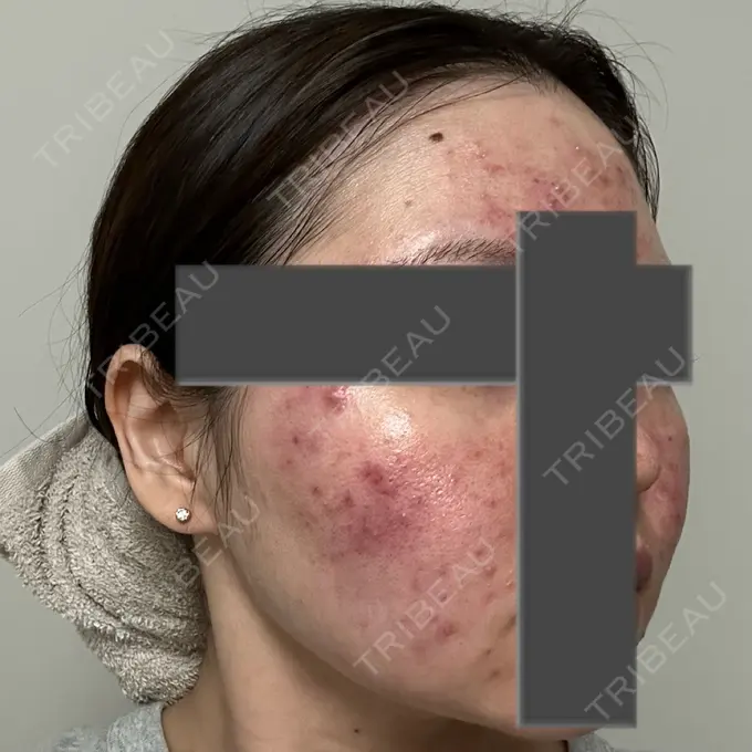 ニードルRF（ポテンツァなど） 東京美容外科 池袋院 DAY 2 メイン用