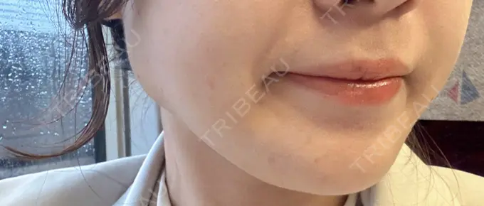 ボトックス（エラ・小顔） / 脂肪溶解注射（顔） CLINIC W DAY 2 メイン用