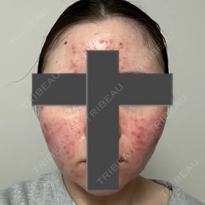 ニードルRF（ポテンツァなど） 東京美容外科 池袋院 DAY 3 メイン用