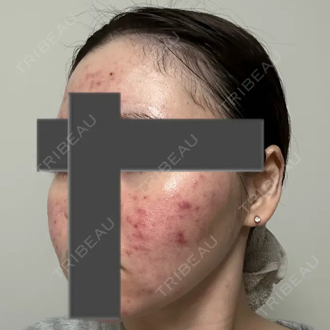 ニードルRF（ポテンツァなど） 東京美容外科 池袋院 DAY 3 メイン用