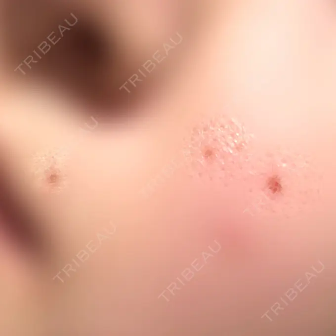 ほくろ・いぼ除去レーザー（肌） Fellez Clinic【フェルズクリニック】 DAY 13 メイン用