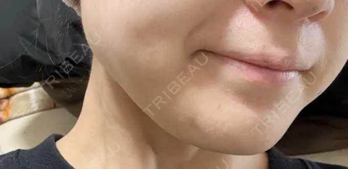 ボトックス（エラ・小顔） / 脂肪溶解注射（顔） CLINIC W DAY 3 メイン用