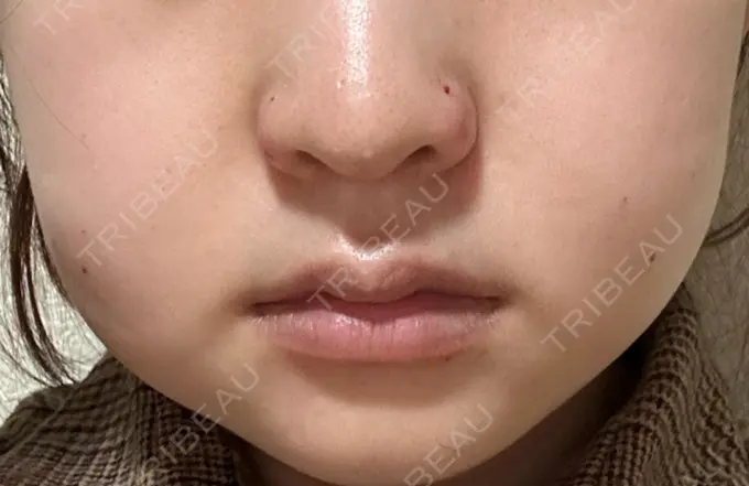 脂肪溶解注射（顔） 表参道ウィズ・クリニック DAY 0 メイン用