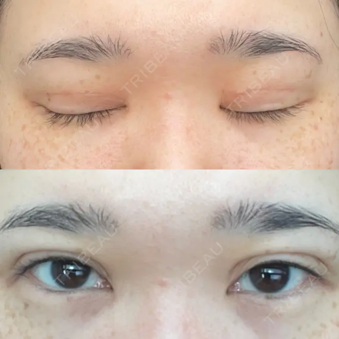 二重埋没 / 上まぶたの脂肪取り TCB東京中央美容外科 六本木院 AFTER メイン用