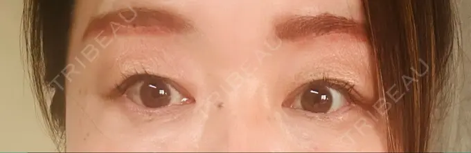 眉下切開 ルーチェクリニック 銀座院 AFTER メイン用