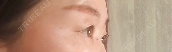 眉下切開 ルーチェクリニック 銀座院 DAY 35 メイン用