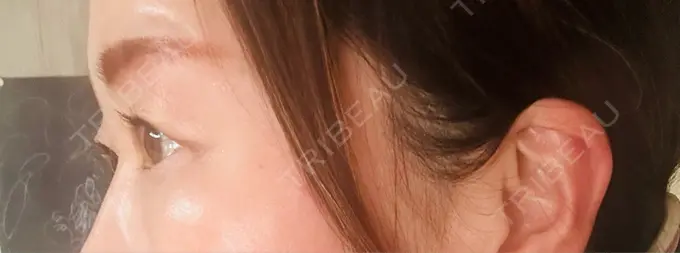 眉下切開 ルーチェクリニック 銀座院 DAY 35 メイン用