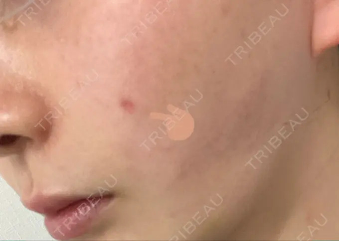 ほくろ・いぼ切除（肌） バログ医院 江南院 DAY 12 メイン用