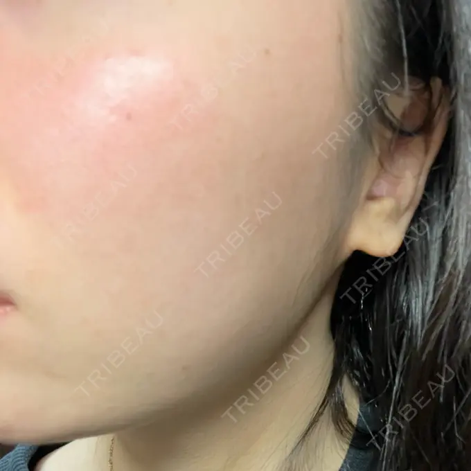 光治療（フォトフェイシャルなど） B-LINE CLINIC 池袋院 AFTER メイン用