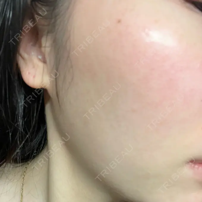 光治療（フォトフェイシャルなど） B-LINE CLINIC 池袋院 DAY 9 メイン用