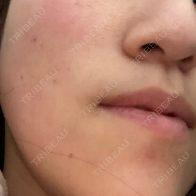 シミ取りレーザー Mavie Beauty Clinic （マヴィービューティークリニック） DAY 5 メイン用