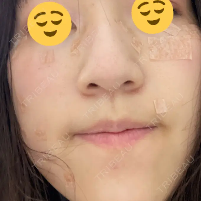 シミ取りレーザー Mavie Beauty Clinic （マヴィービューティークリニック） DAY 6 メイン用